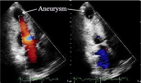 what is an apical aneurysm